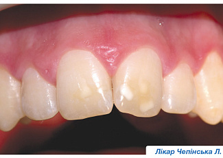 Переваги G-aenial при реставруванні флюорозних зубів
