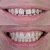 Клінічний випадок естетичного відновлення твердих тканин зуба вінірами 
