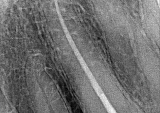 SURE-SEAL ROOT – матеріал для складних клінічних випадків обтурації кореневих каналів