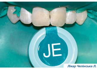 Переваги G-aenial при реставруванні флюорозних зубів