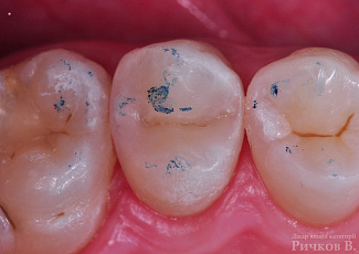 Реставрація  25 зуба за допомогою G-AENIAL  з використанням декількох барвників OPTIGLAZE Color
