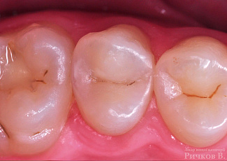 Реставрація  25 зуба за допомогою G-AENIAL  з використанням декількох барвників OPTIGLAZE Color