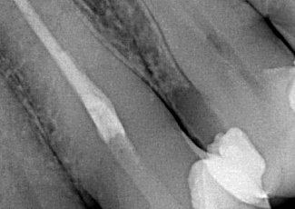 SURE-SEAL ROOT – матеріал для складних клінічних випадків обтурації кореневих каналів