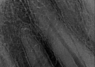 SURE-SEAL ROOT – матеріал для складних клінічних випадків обтурації кореневих каналів