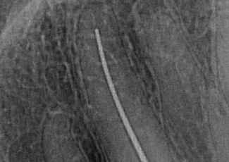 SURE-SEAL ROOT – матеріал для складних клінічних випадків обтурації кореневих каналів